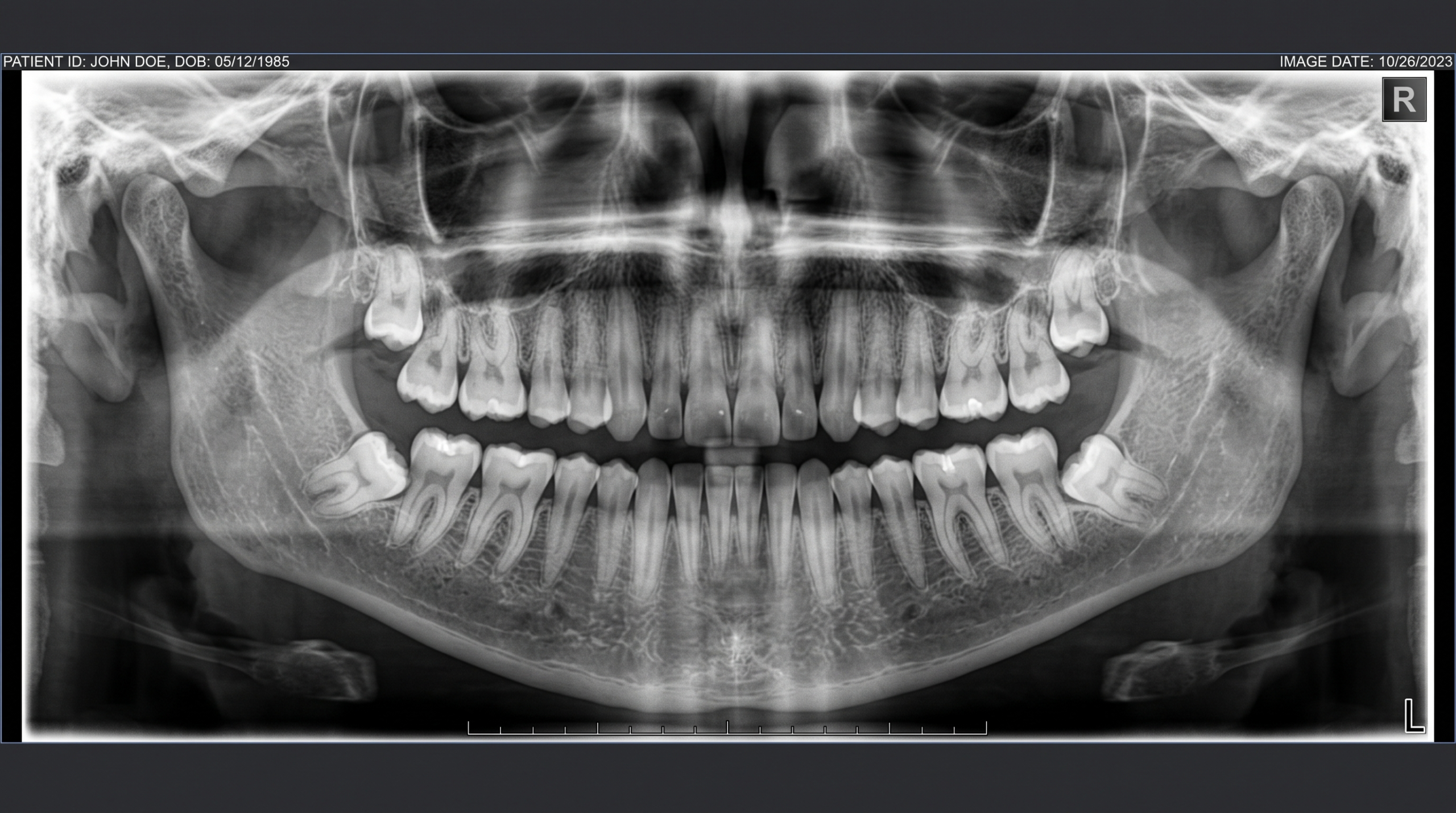 Radiografía panorámica dental mostrando la posición de los cordales o muelas del juicio