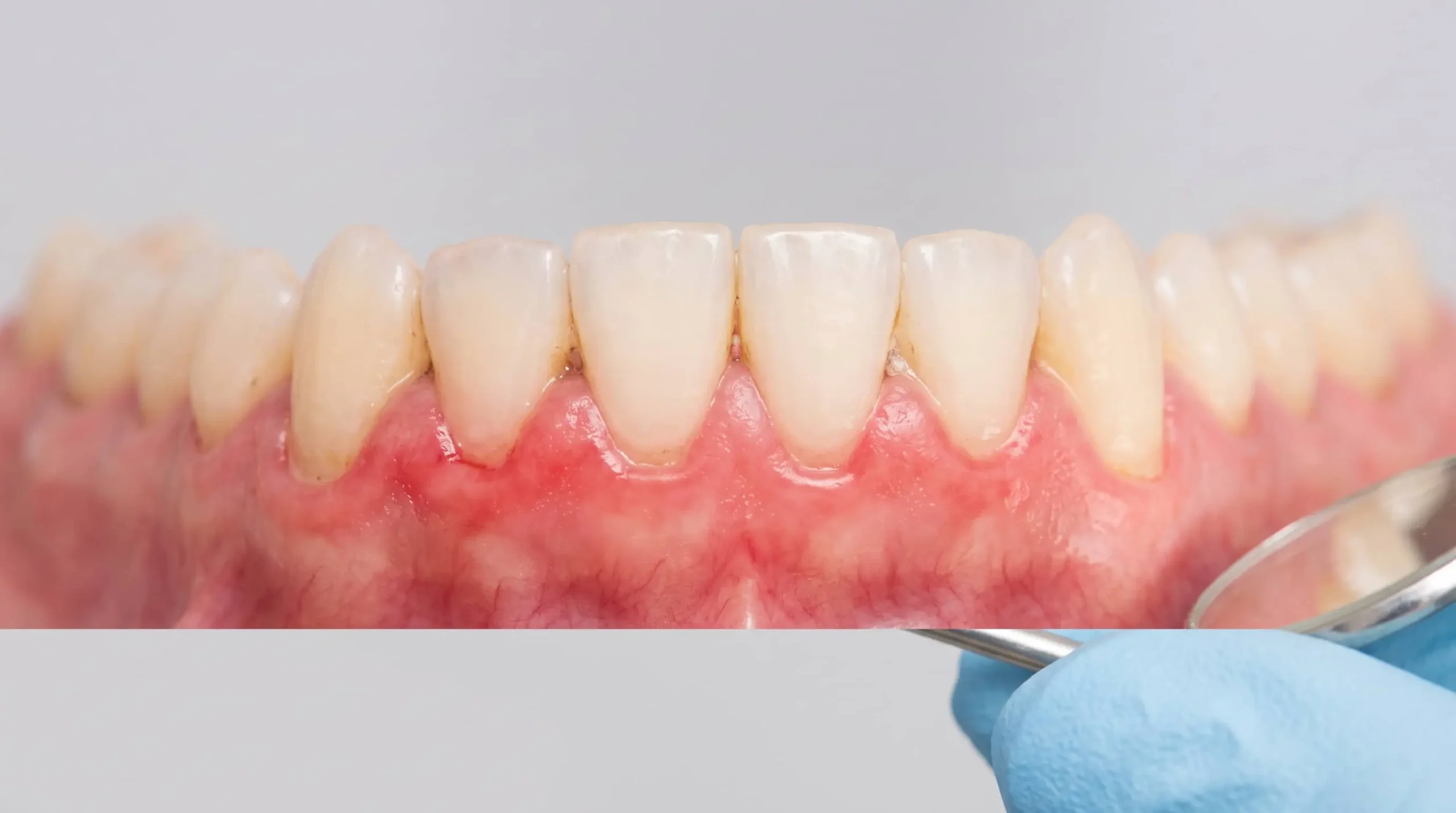 Primer plano de encías inflamadas y enrojecidas junto a los dientes, sin rostro visible